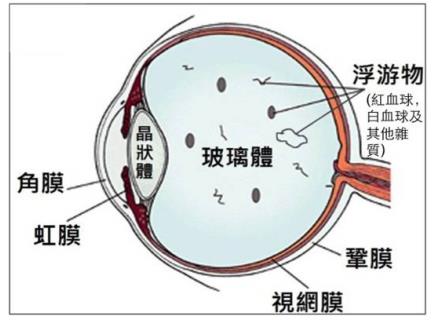 飛蚊癥導(dǎo)致視網(wǎng)膜脫落