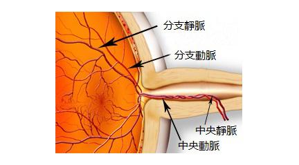 視網(wǎng)膜中央靜脈阻塞的癥狀