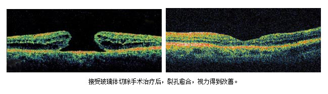 看東西變形