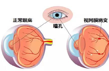 昆明眼科醫(yī)院，全家眼健康檢查，視網(wǎng)膜病變/脫落，高度近視