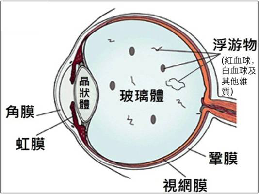 飛蚊癥狀