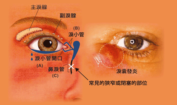 淚道阻塞是什么