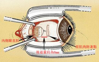 斜視手術(shù)治療方法