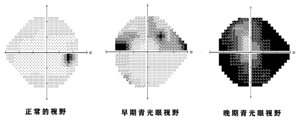 急性青光眼和慢性青光眼