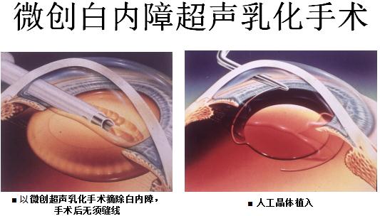 白內(nèi)障藥物治療