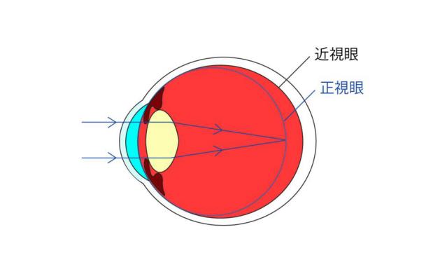 矯正近視