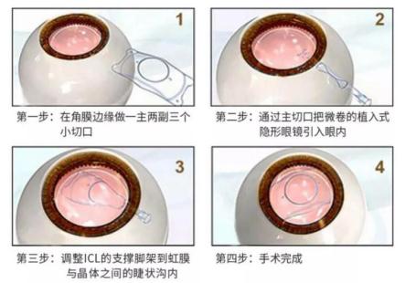 昆明ICL晶體植入術(shù)醫(yī)院