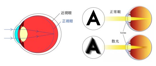 散光是什么原因造成的