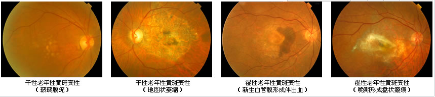 眼睛黃斑是什么？有什么危害