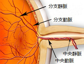 眼中風(fēng)是什么