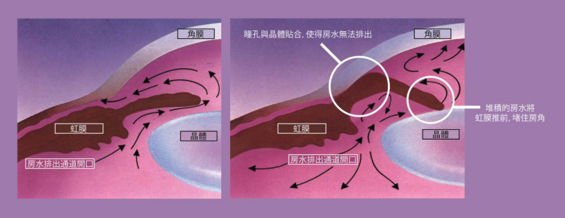 青光眼什么治療方式好