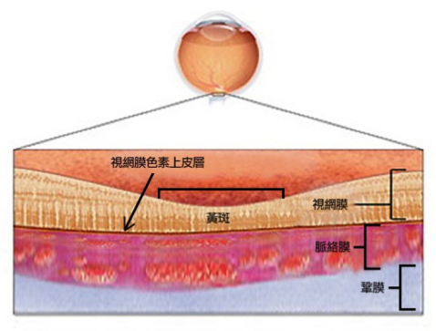 眼中漿嚴(yán)重嗎？可以治好嗎