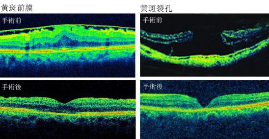 老年黃斑退化怎么治療