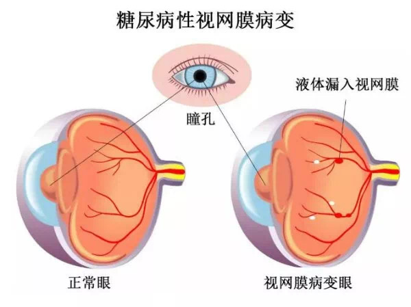 糖尿病視網(wǎng)膜病變嚴(yán)重嗎