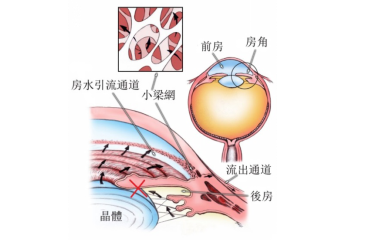 昆明青光眼和白內(nèi)障能夠一起治療嗎