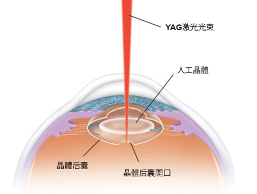 白內(nèi)障風(fēng)險(xiǎn)大嗎？會復(fù)發(fā)嗎？