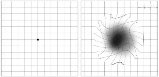 眼睛看東西變形、視物中央有黑點(diǎn)是怎么回事？