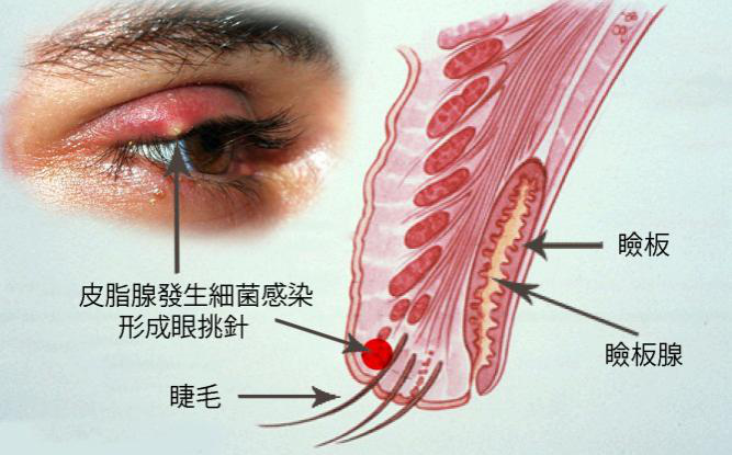 麥粒腫和霰粒腫怎么區(qū)別？