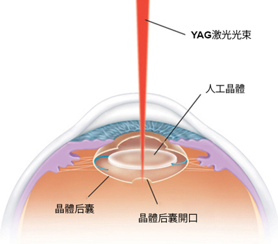 飛蚊癥嚴(yán)重嗎？不治療會怎么樣