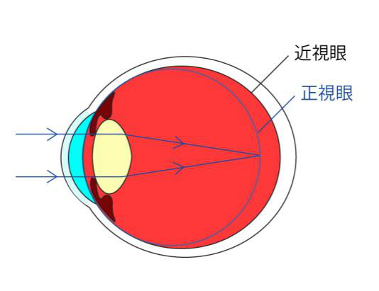 近視眼手術(shù)