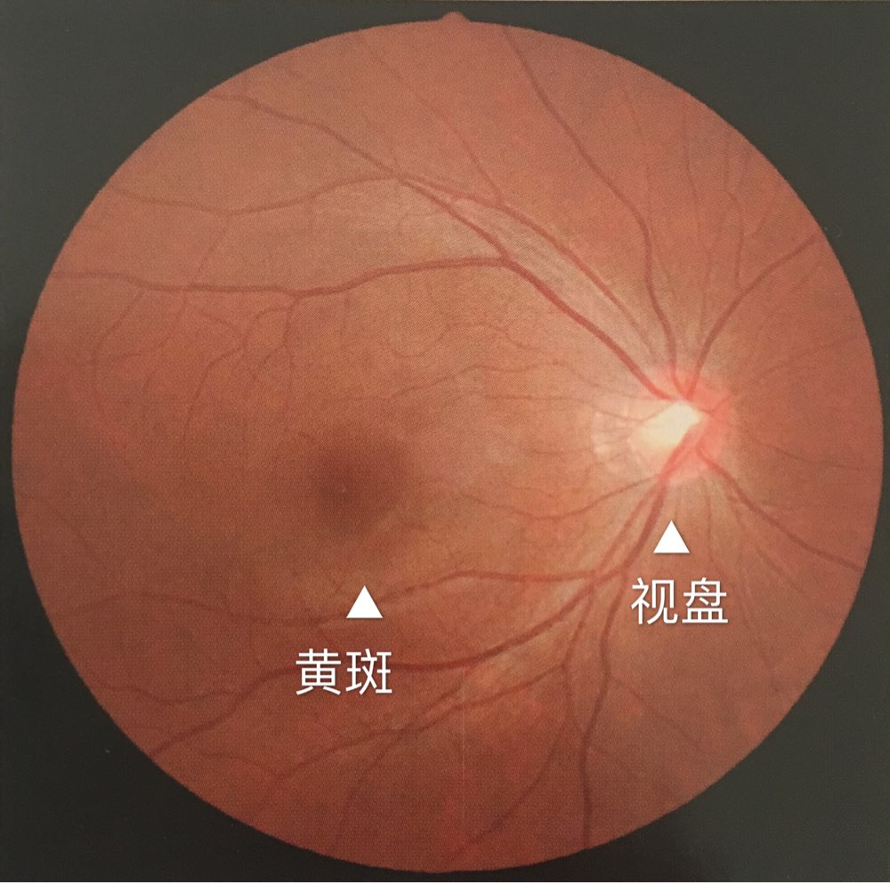 高度近視患者易導(dǎo)致視網(wǎng)膜脫落