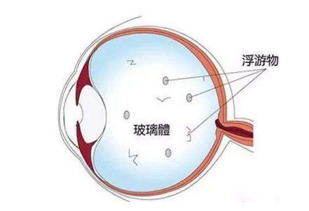 飛蚊癥怎么治