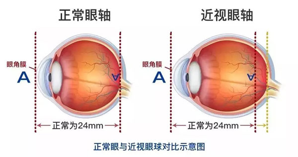 近視眼與正常人的眼睛對比圖