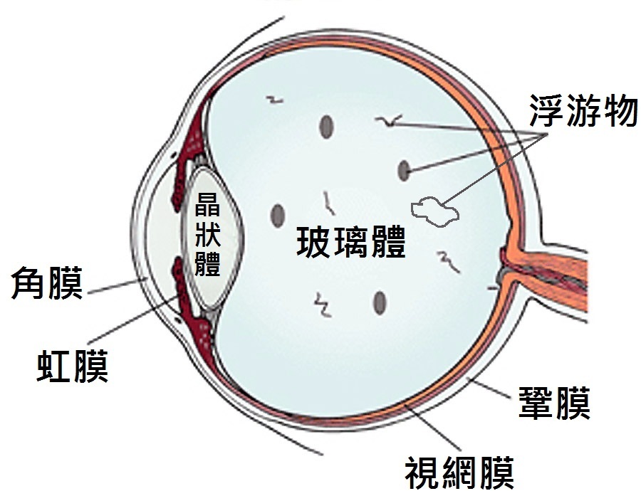 玻璃體渾濁怎么治