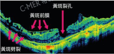 黃斑病變