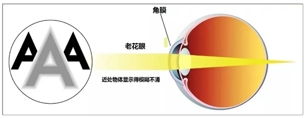 昆明老花眼成因