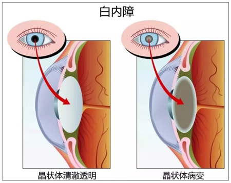 昆明白內(nèi)障成因